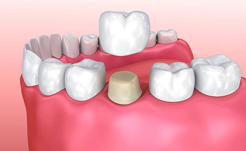 Dental Crown Placement