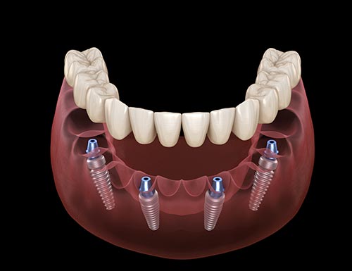 all-on-four-dental-implants