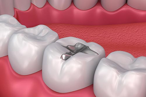 dental-fillings