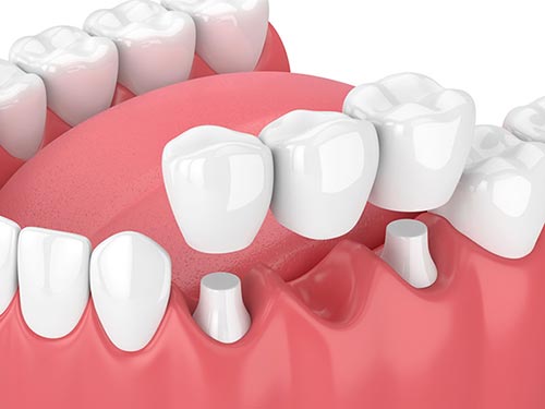 traditional-dental-bridge